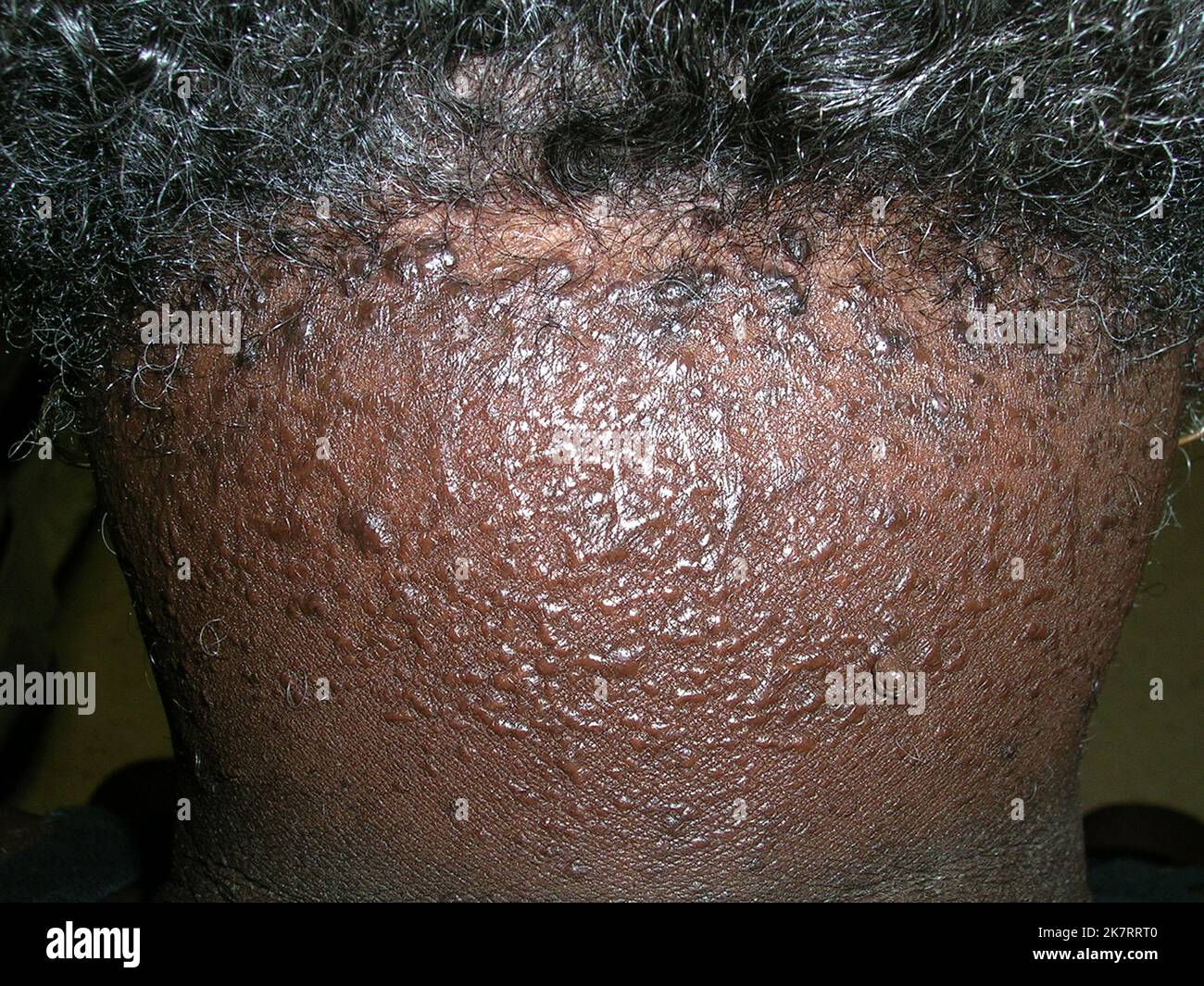 The Difference Between Folliculitis and Hidradenitis Suppurativa  myHSteam