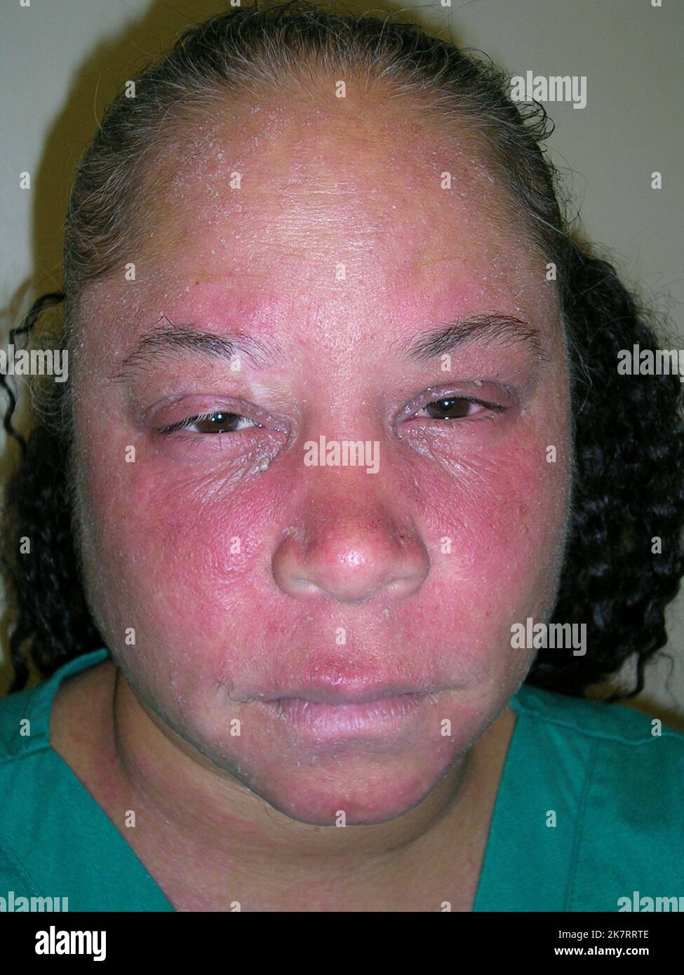 Atopic dermatitis on the face of a female patient. Atopic dermatitis