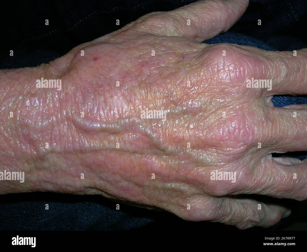 Atopic dermatitis on the hand of a white female patient. Atopic ...
