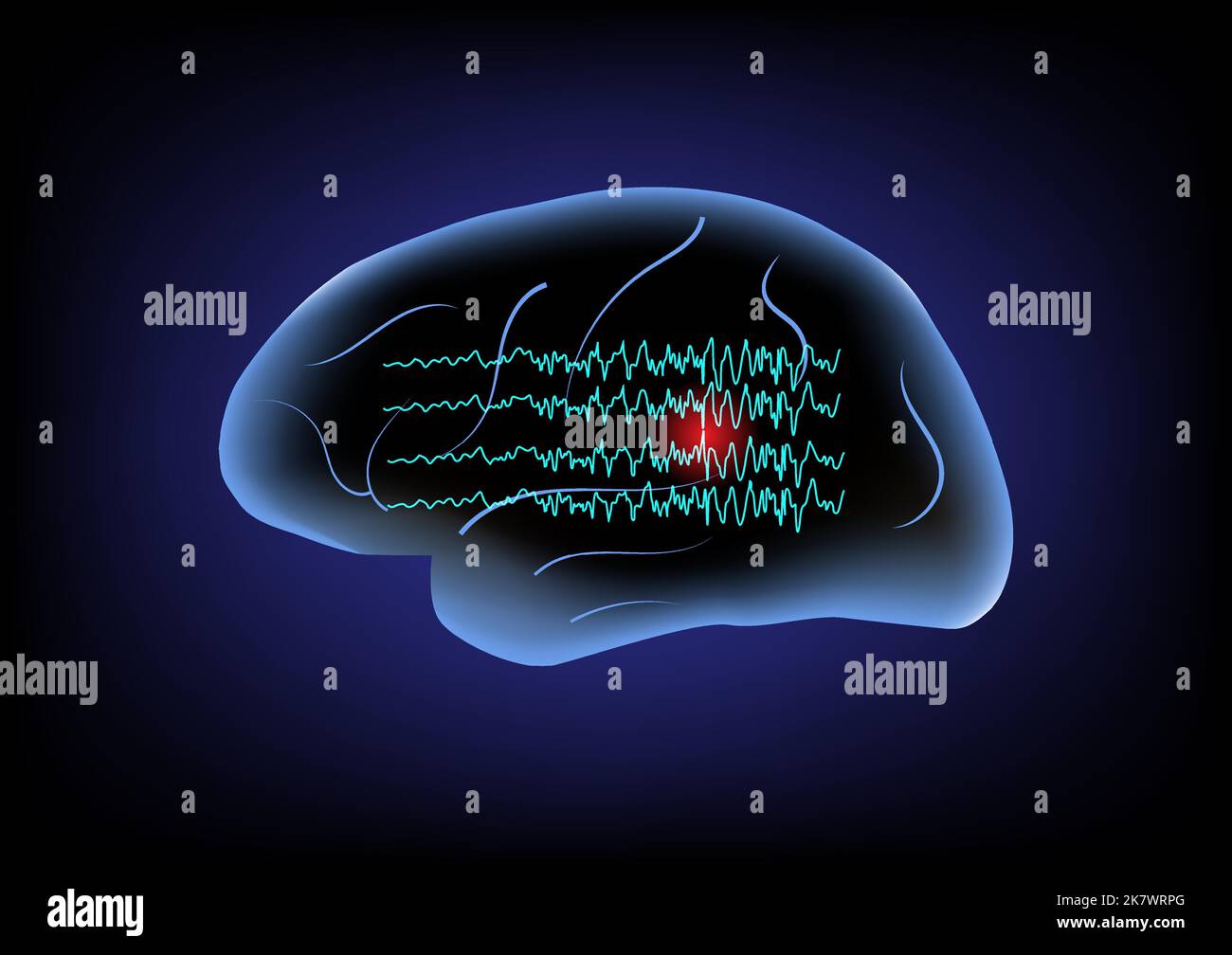 Illustration of human brain and brain waves. Concept of focal seizure. Stock Vector