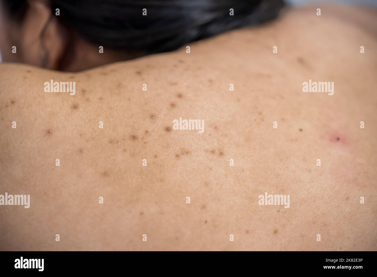 Acne on the back of the skin care woman is caused by bacteria Stock