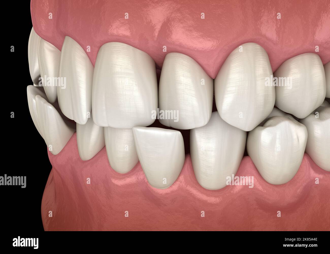 Anterior crossbite dental occlusion ( Malocclusion of teeth