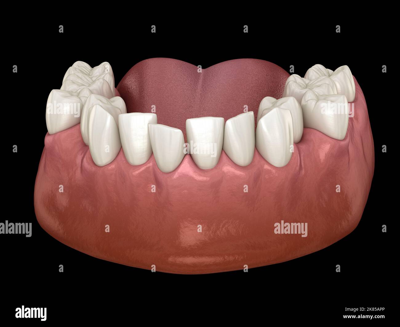 Overcrowded teeth, abnormal dental occlusion. Medically accurate tooth