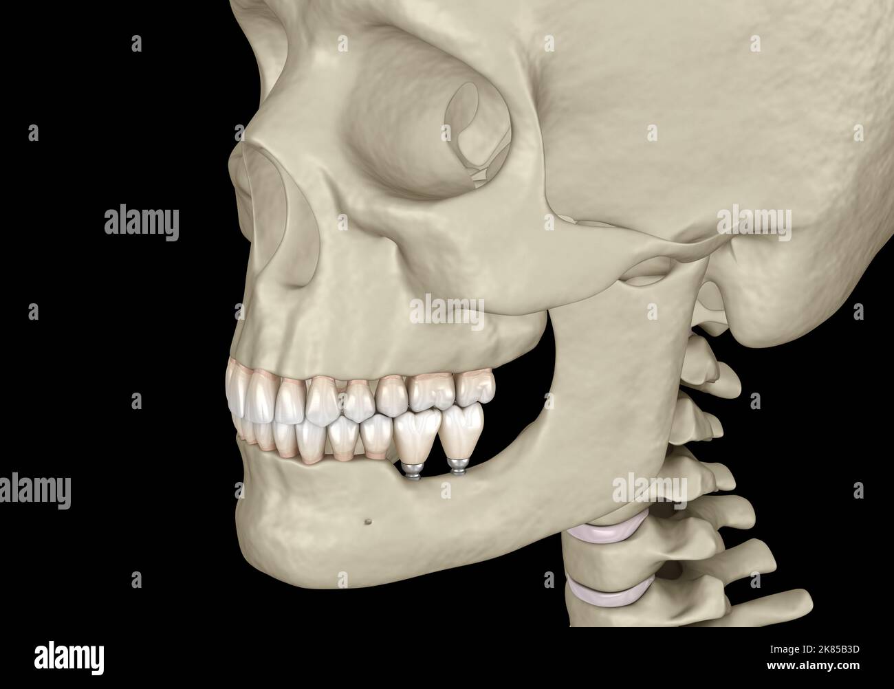 Implantation with mini implants in to recessed jaw bone Medically