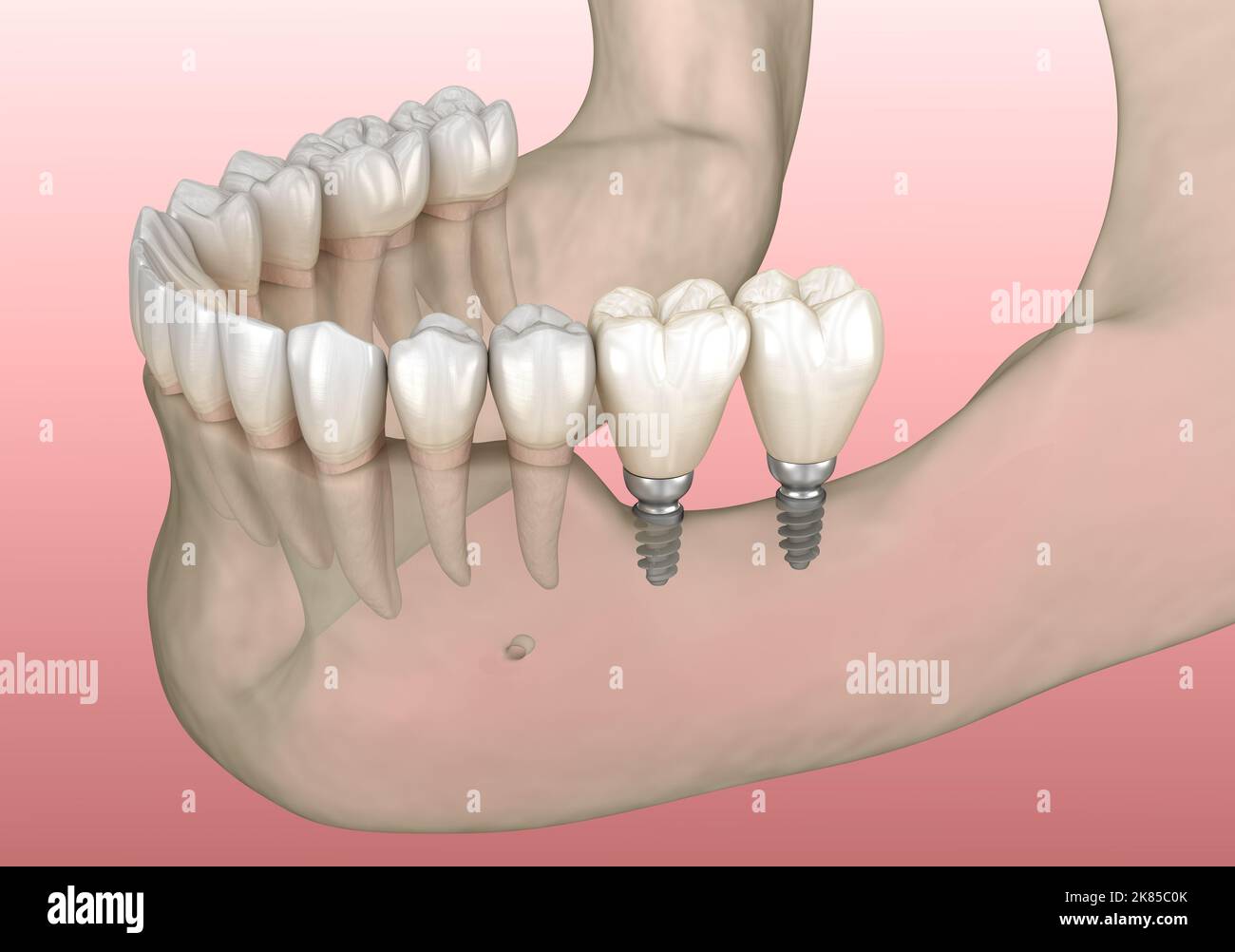 Implantation with mini implants in to recessed jaw bone Medically accurate 3D illustration