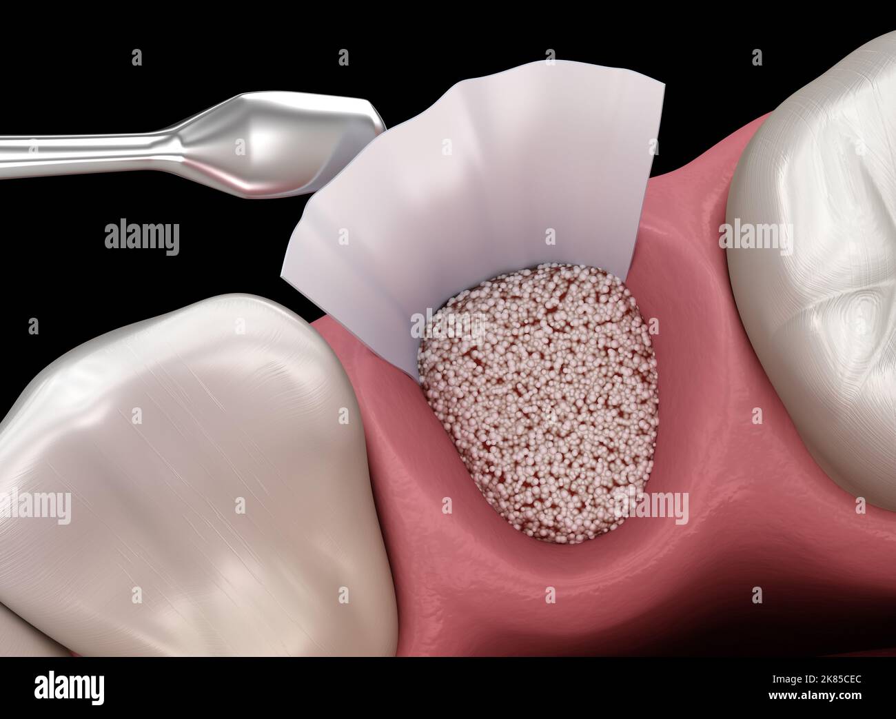 Augmentation Surgery Adding bone after tooth extraction. 3D