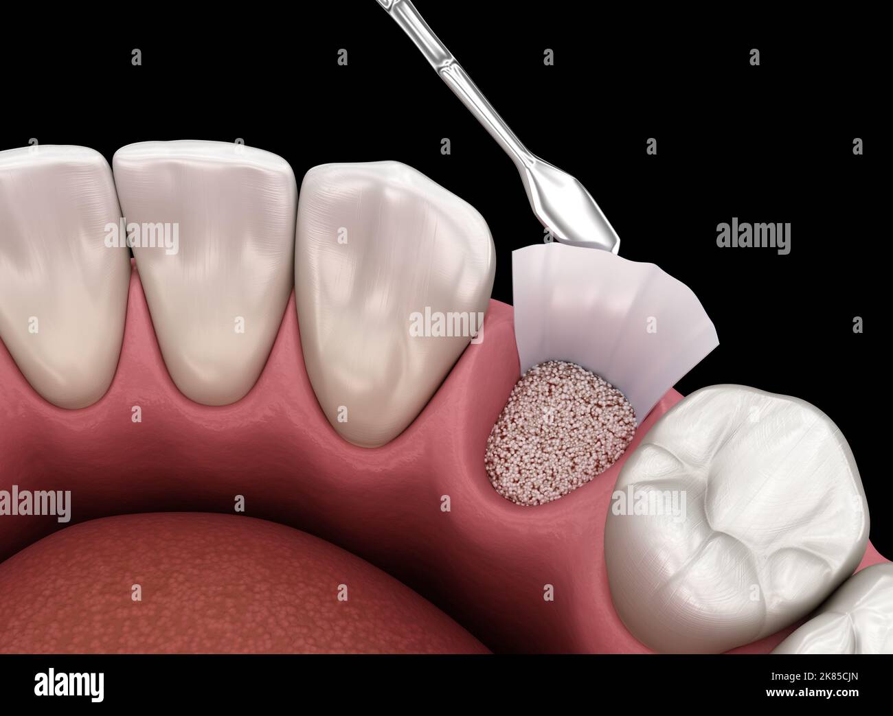 Augmentation Surgery Adding bone after tooth extraction. 3D