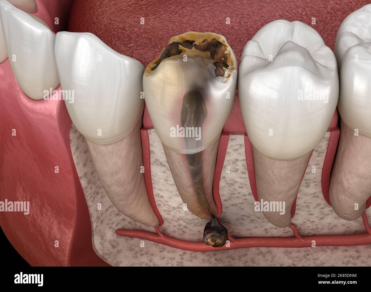 Periostitis tooth Lump on Gum Above Tooth. Medically accurate dental