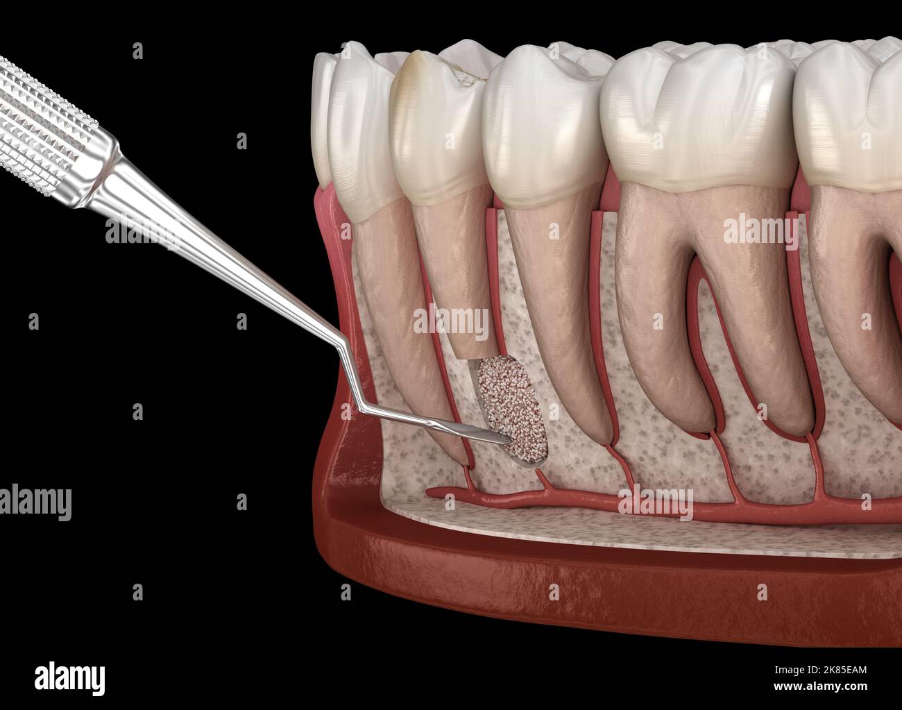 Tooth Cystectomy Surgery recovery after Periostitis . Medically