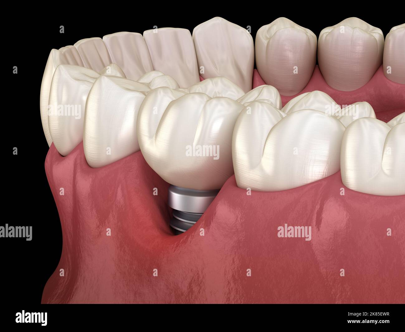 Periimplantitis with visible gum recession. Medically accurate 3D