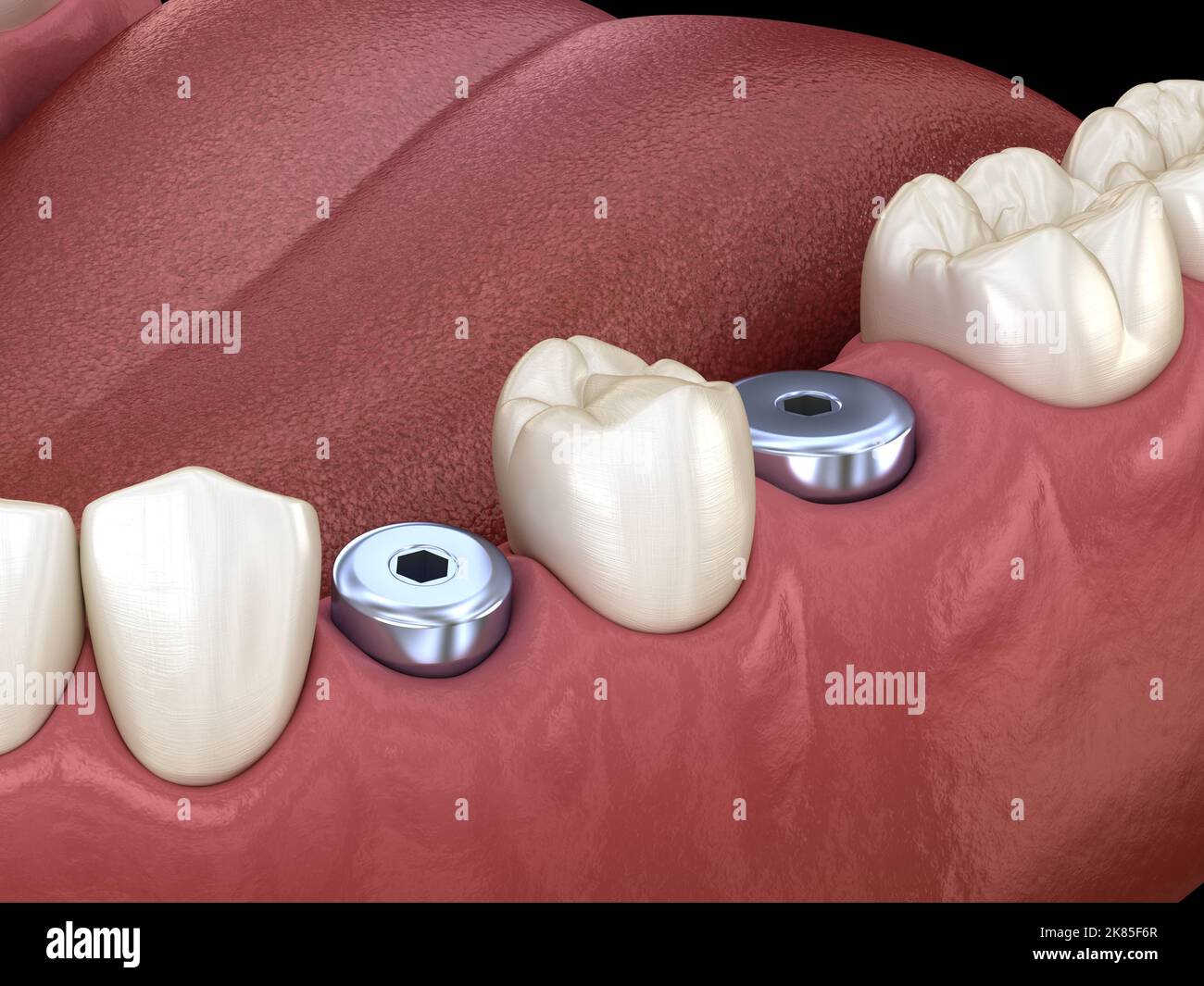 Temporary Implant abutments. Medically accurate 3D illustration of human teeth and dentures