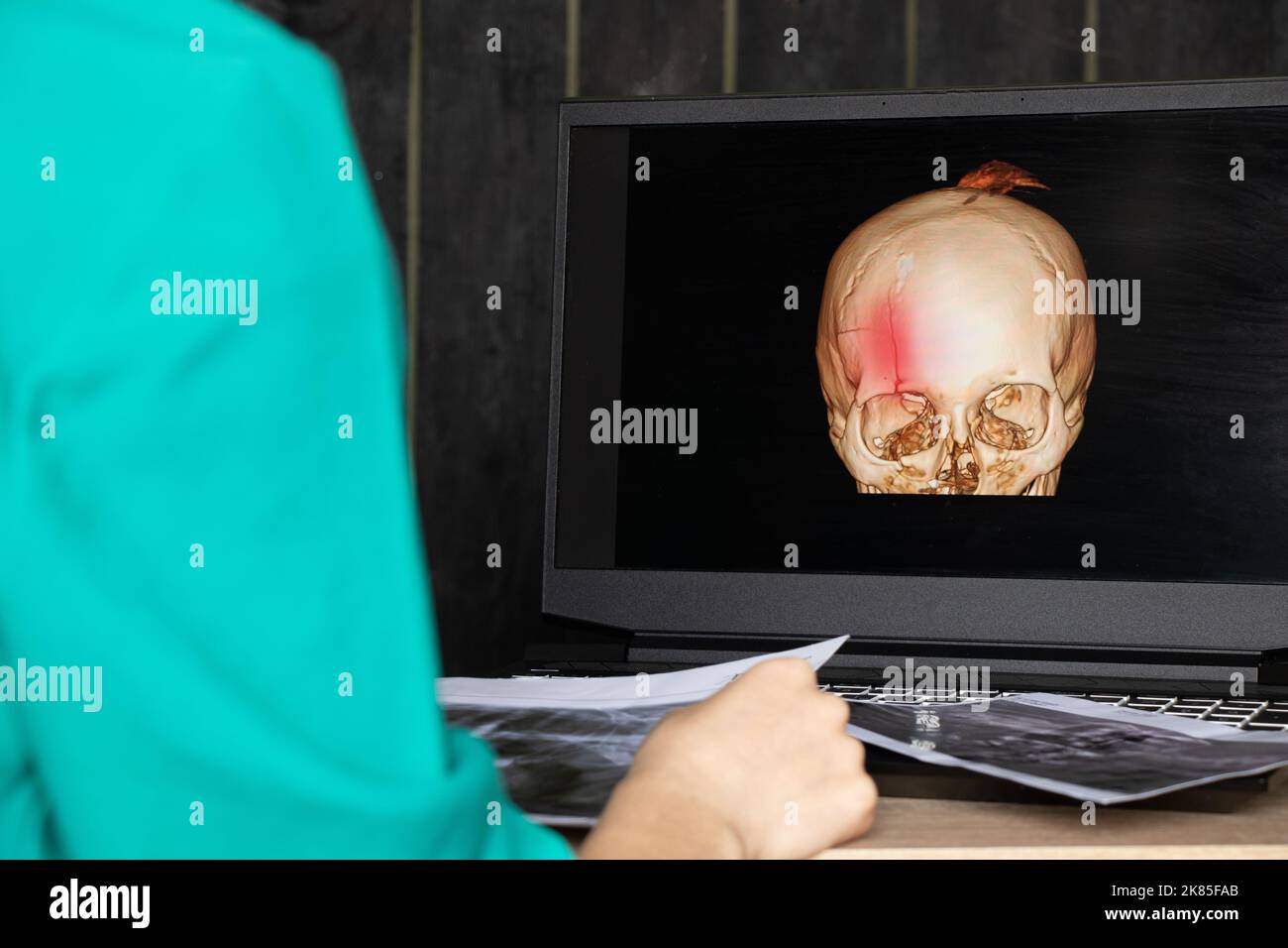 3D computed tomography of the brain with a fracture of the frontal part of the skull after injury on laptop screens on the table on laptop screens at Stock Photo