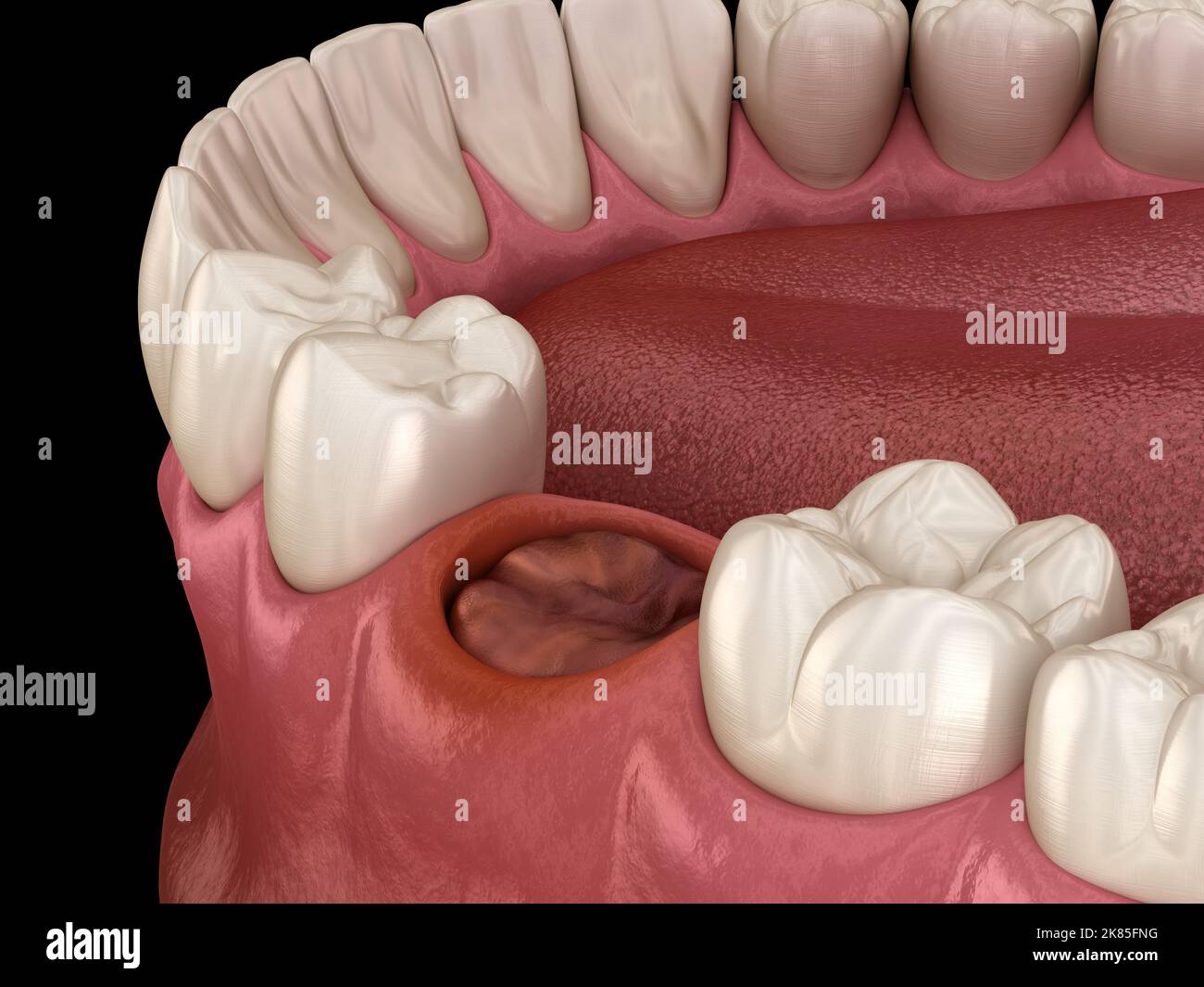 The blood clot seals off the tooth after extraction. Medically accurate