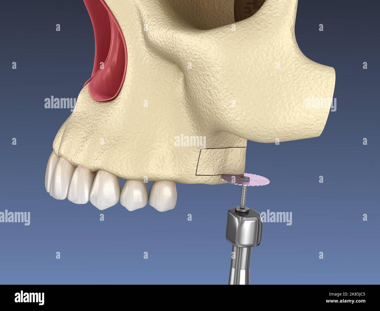 Sinus Lift Surgery - Sinus Augmentation. 3D illustration Stock Photo - Alamy