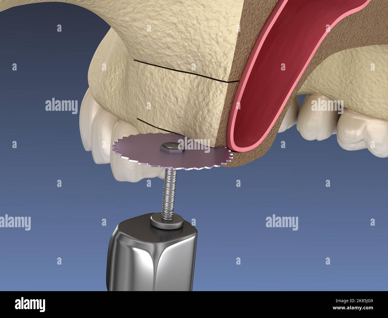 Sinus lifting hi-res stock photography and images - Alamy