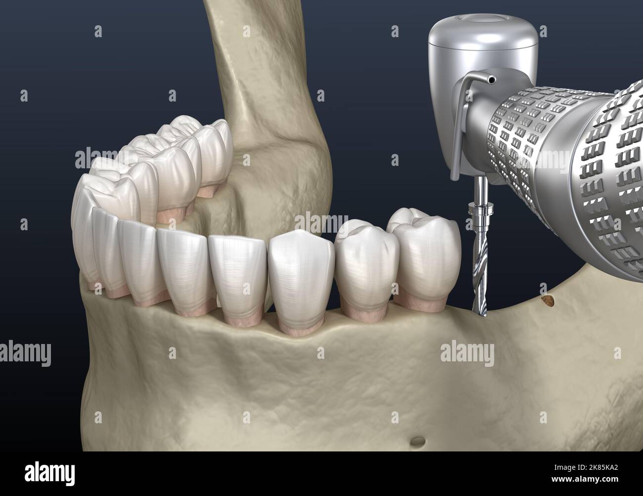 Cleavage of the alveolar ridge, augmentation. Dental surgery, 3D