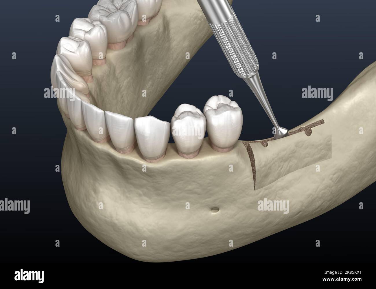 Cleavage of the alveolar ridge, augmentation. Dental surgery, 3D
