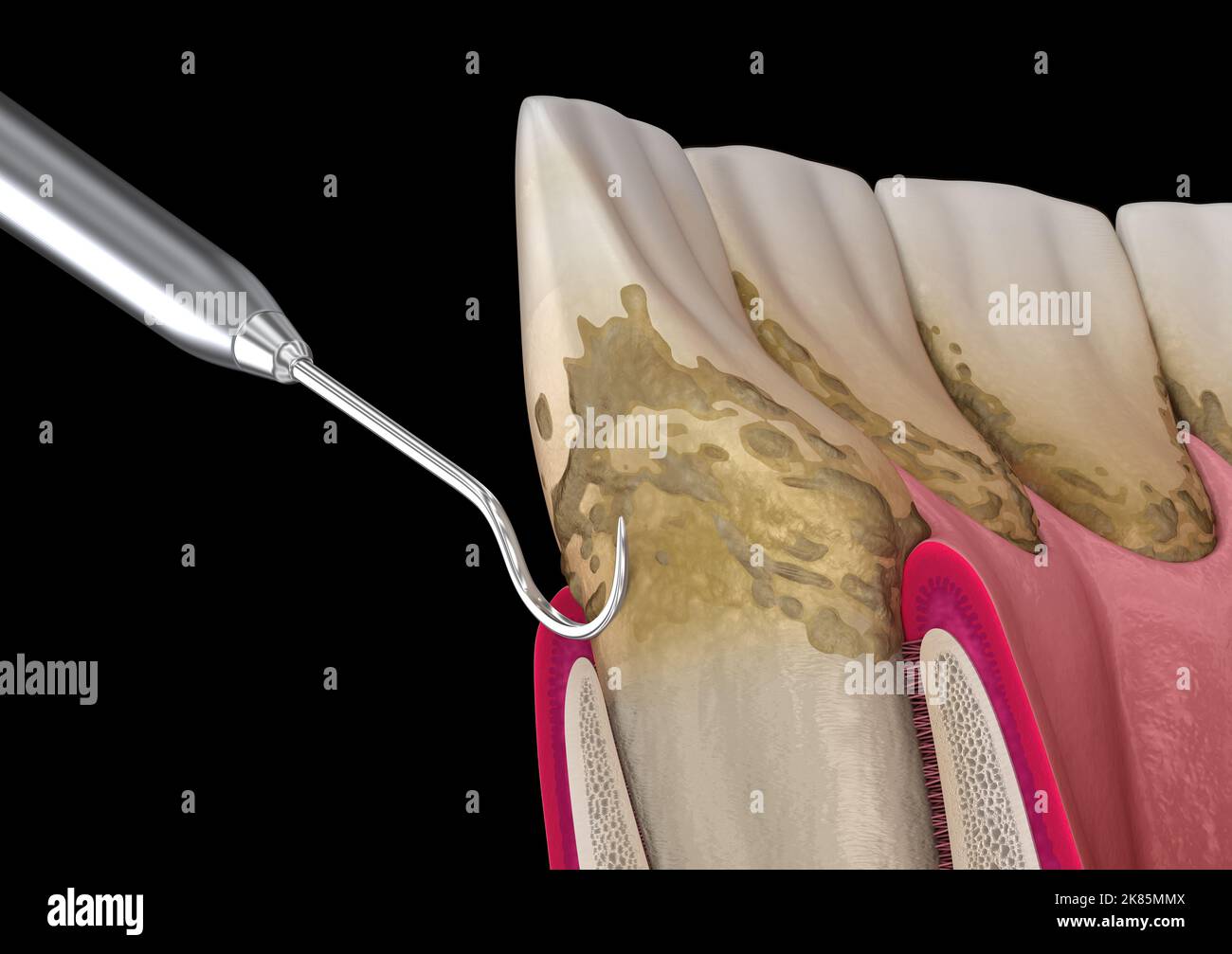 Oral Hygiene Scaling And Root Planing Conventional Periodontal Therapy Medically Accurate 3d 2815