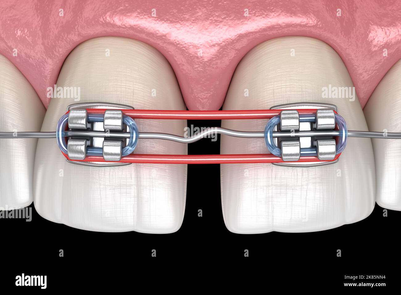 Elastics and metal braces for diastema correction. Medically accurate