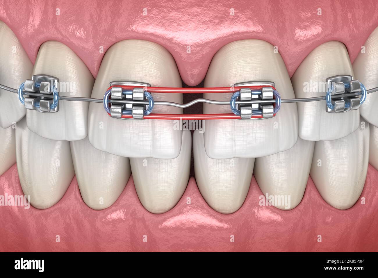 Elastics and metal braces for diastema correction. Medically accurate