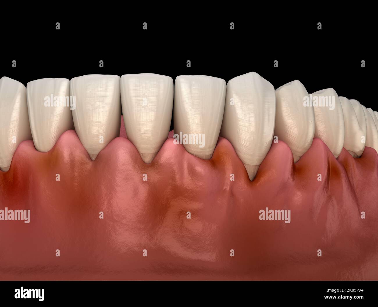 Gingivitis inflammation of the gums. Medically accurate 3D illustration