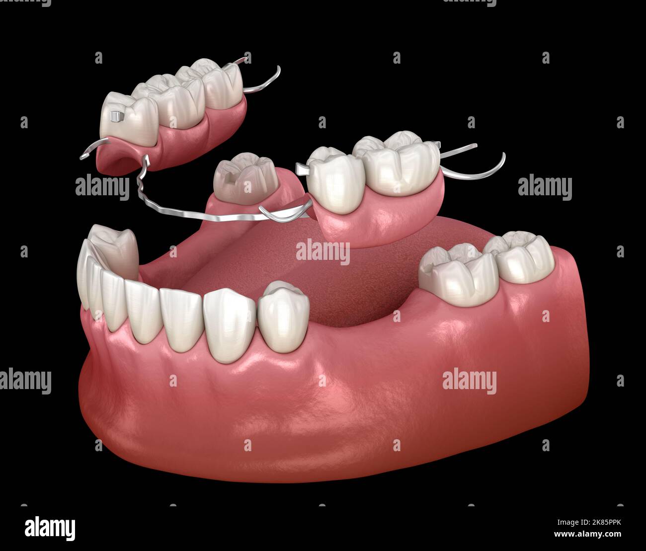 Removable partial denture, mandibular prosthesis. Medically accurate 3D