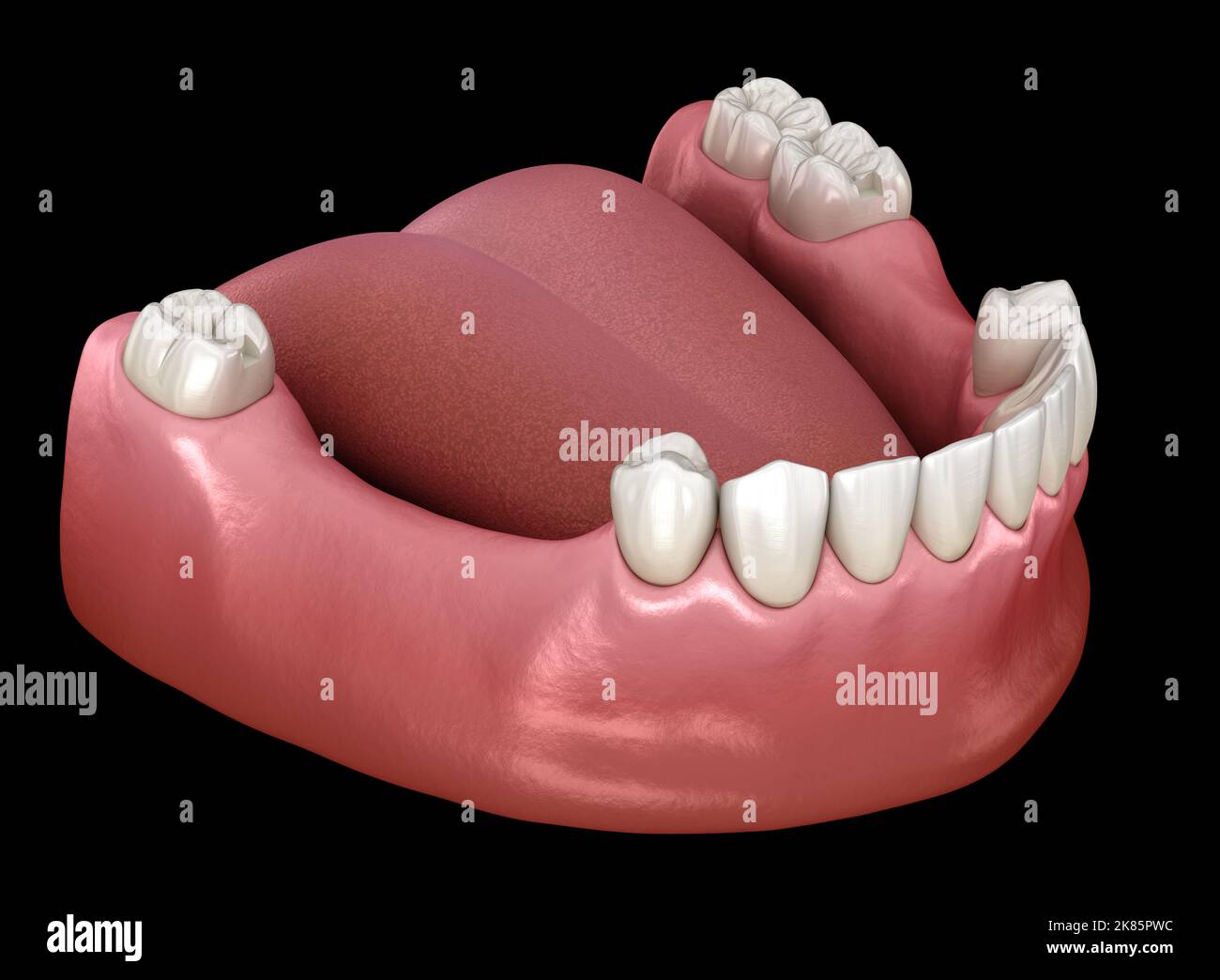 Removable partial denture, mandibular prosthesis. Medically accurate 3D illustration of prosthodontics concept Stock Photo