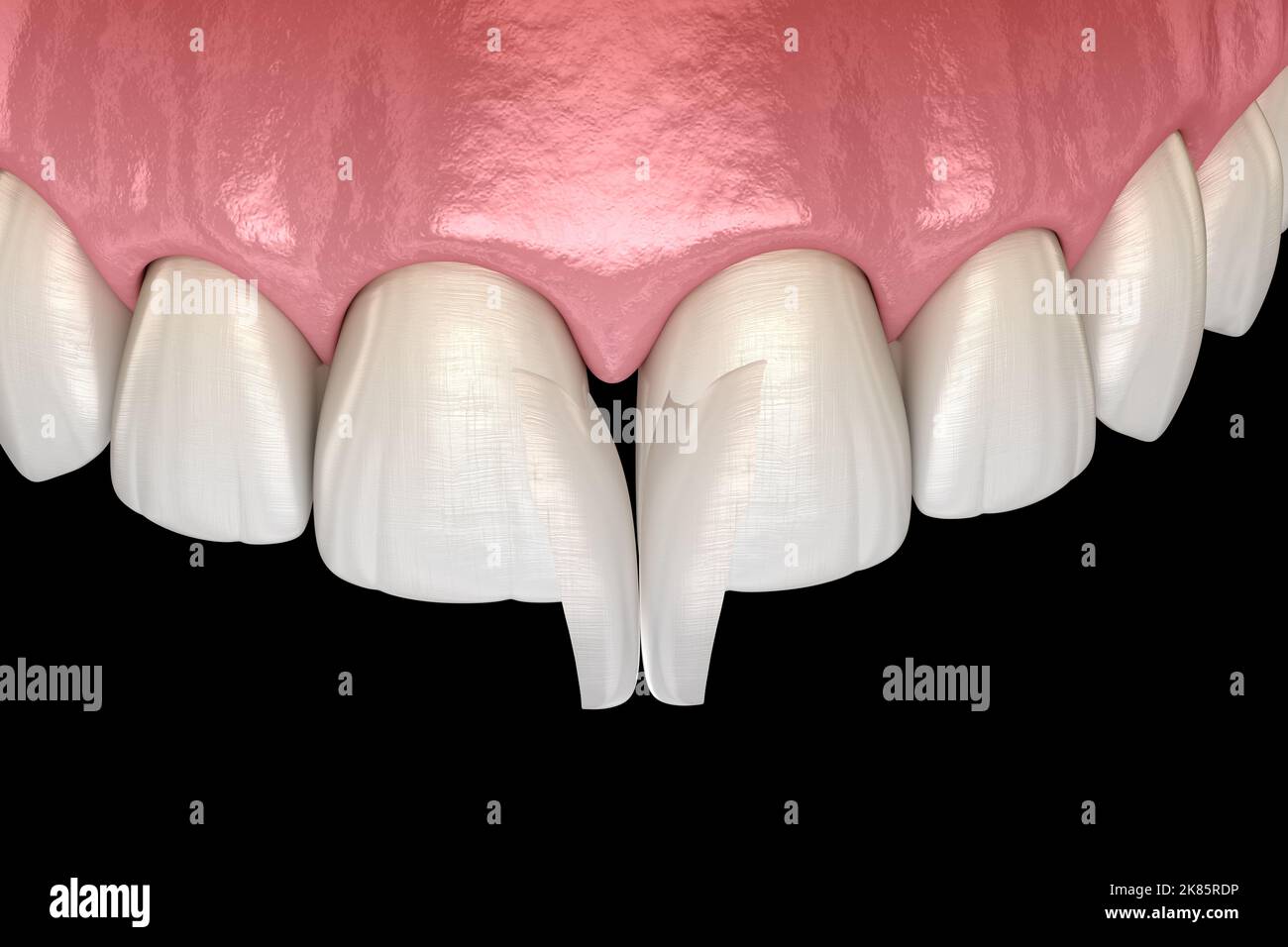 Diastema treatment: Micro veneer installation procedure over central incisor. Medically accurate tooth 3D illustration Stock Photo