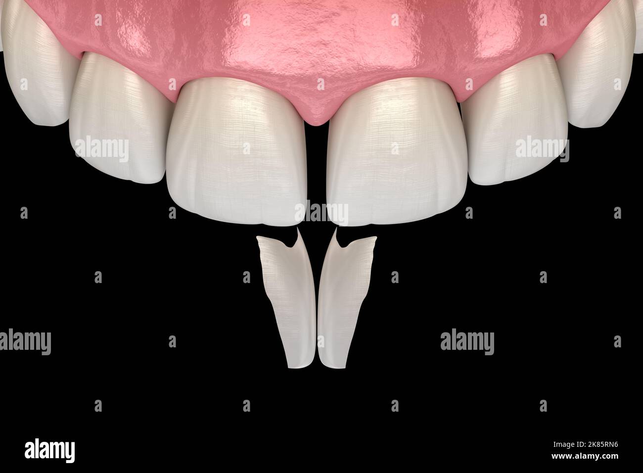 Diastema treatment: Micro veneer installation procedure over central incisor. Medically accurate tooth 3D illustration Stock Photo