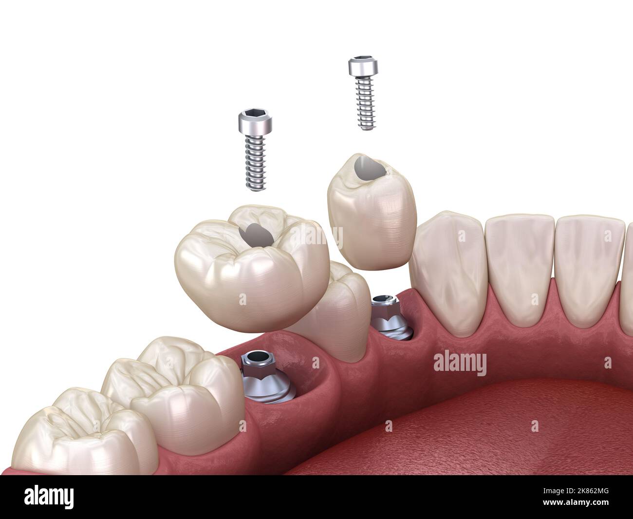 Premolar and Molar tooth crown installation over implant, screw
