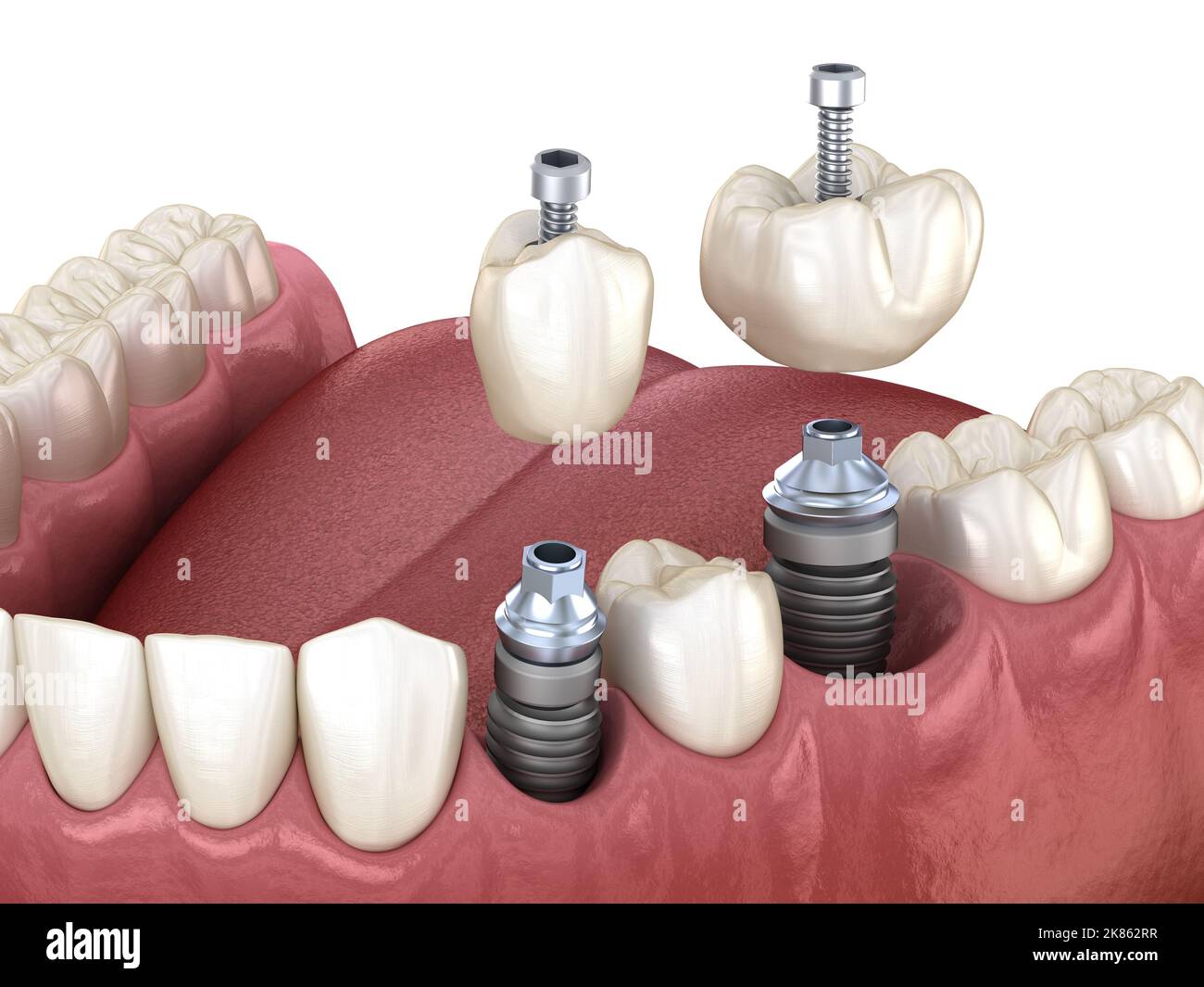 Premolar and Molar tooth crown installation over implant, screw fixation. 3D illustration of dental treatment Stock Photo