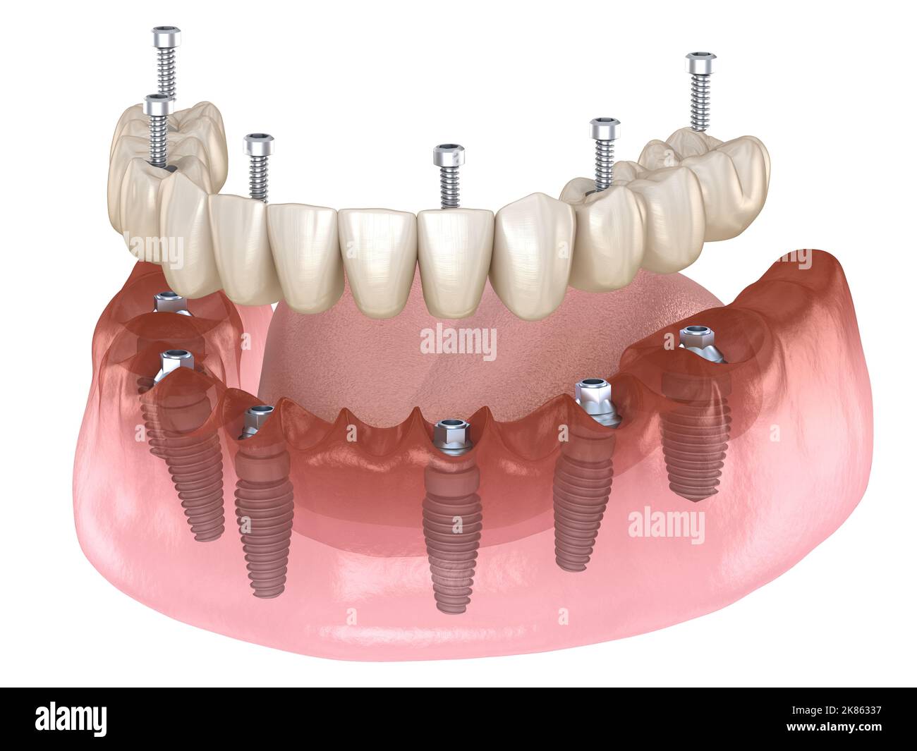 Mandibular prosthesis All on 4 system supported by implants, screw fixation. Medically accurate 3D illustration of dental concept Stock Photo