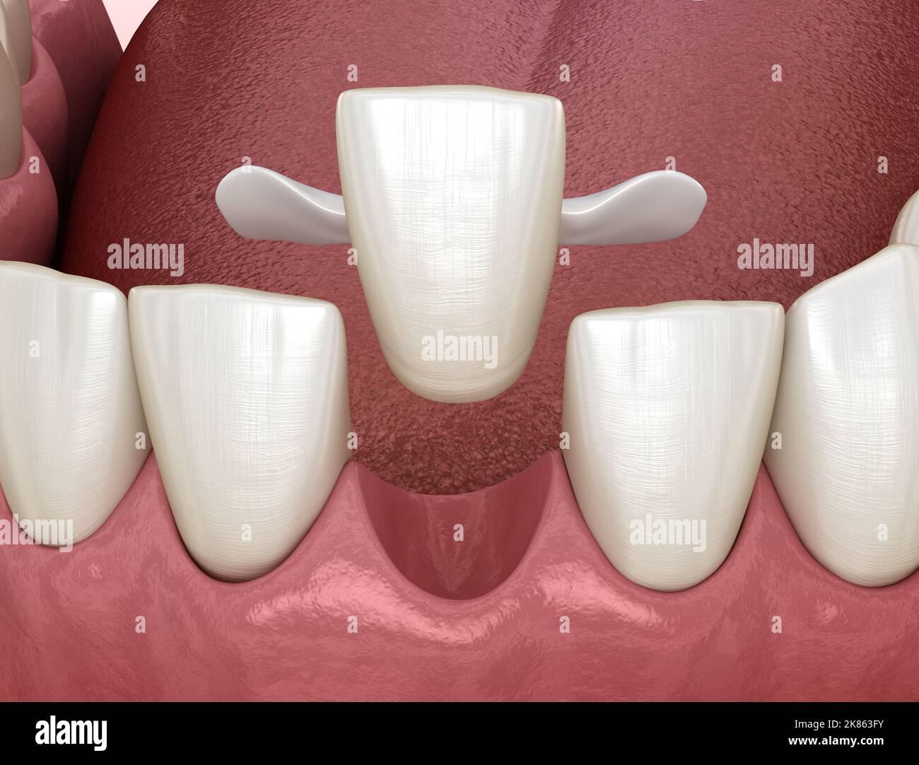 Maryland bridge made from ceramic, front tooth recovery. Medically