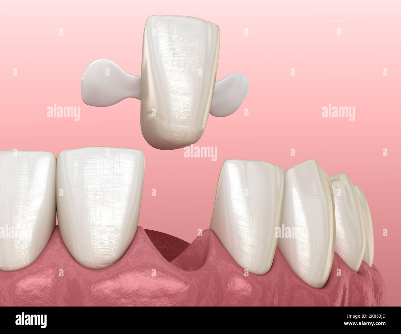 Maryland bridge made from ceramic, front tooth recovery. Medically ...