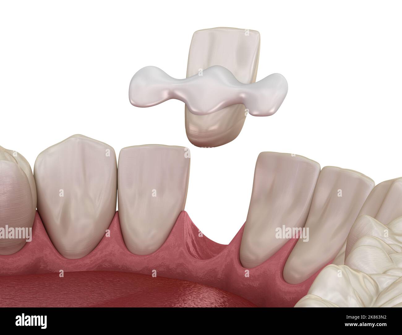 Maryland bridge made from ceramic, front tooth recovery. Medically accurate 3D illustration of