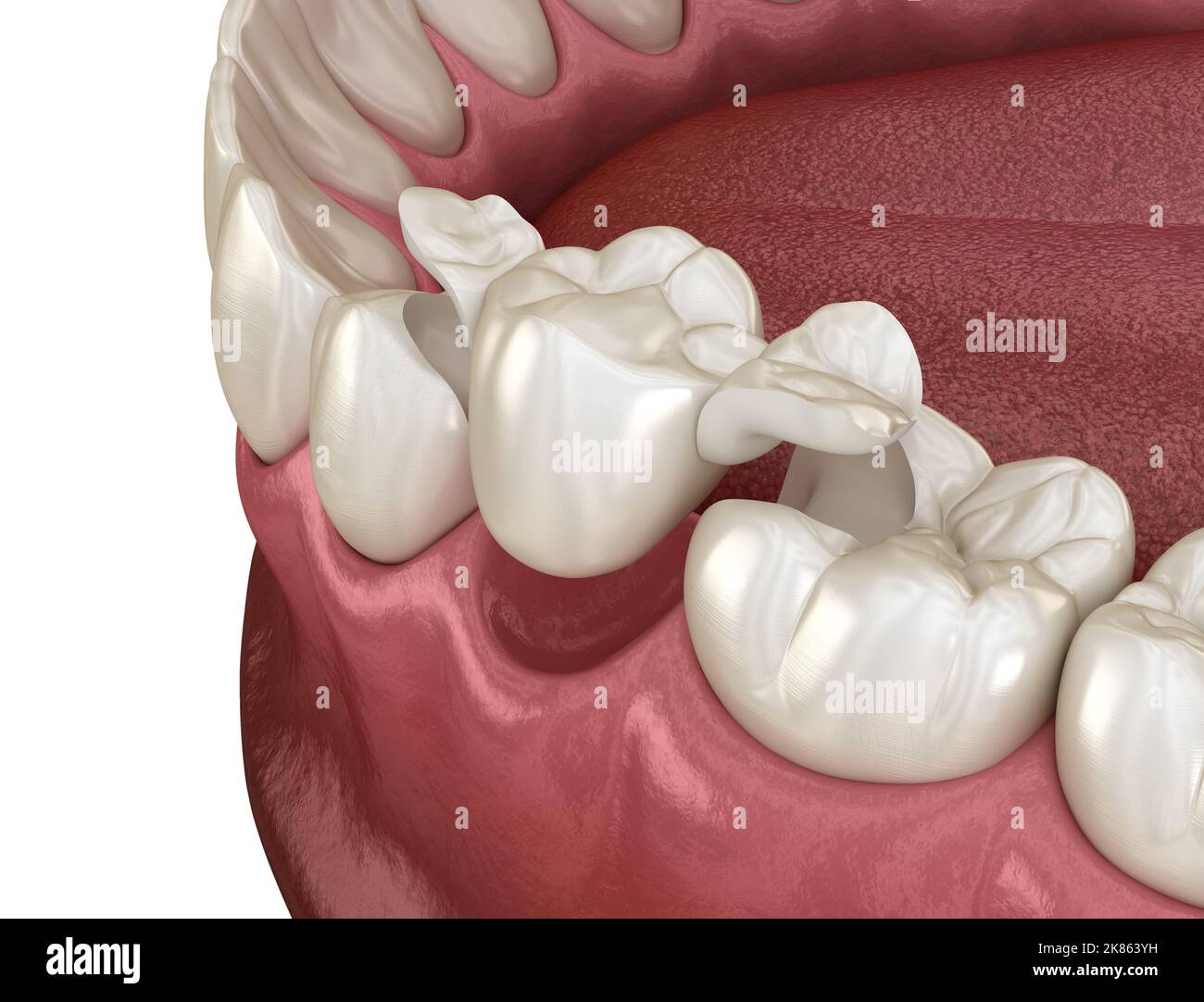 Maryland bridge made from ceramic, premolar tooth recovery. Medically