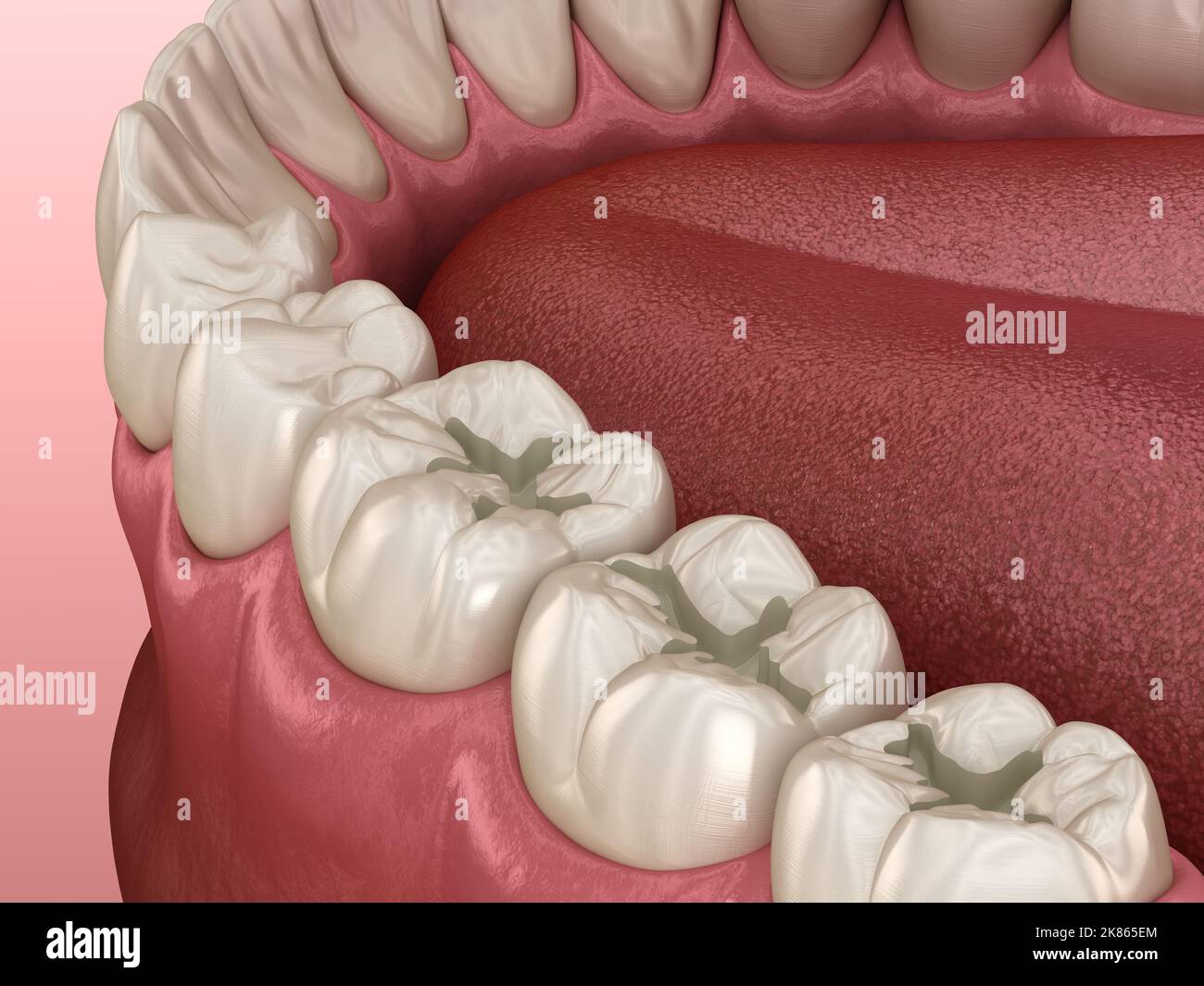 Prepareted Molar Fissure for fillings placement, Medically accurate 3D