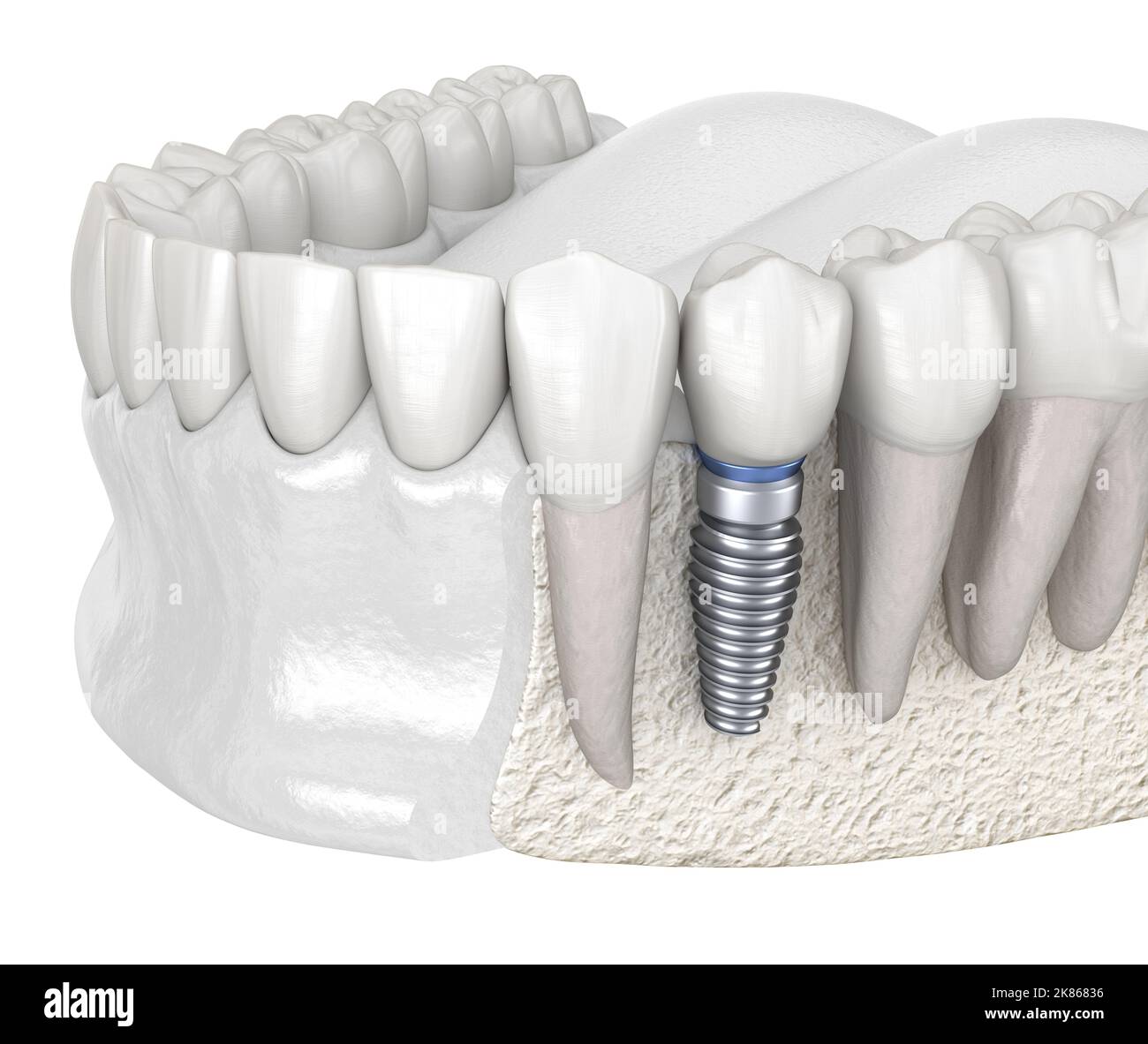 Premolar tooth recovery with implant. Medically accurate 3D illustration of human teeth and dentures concept Stock Photo