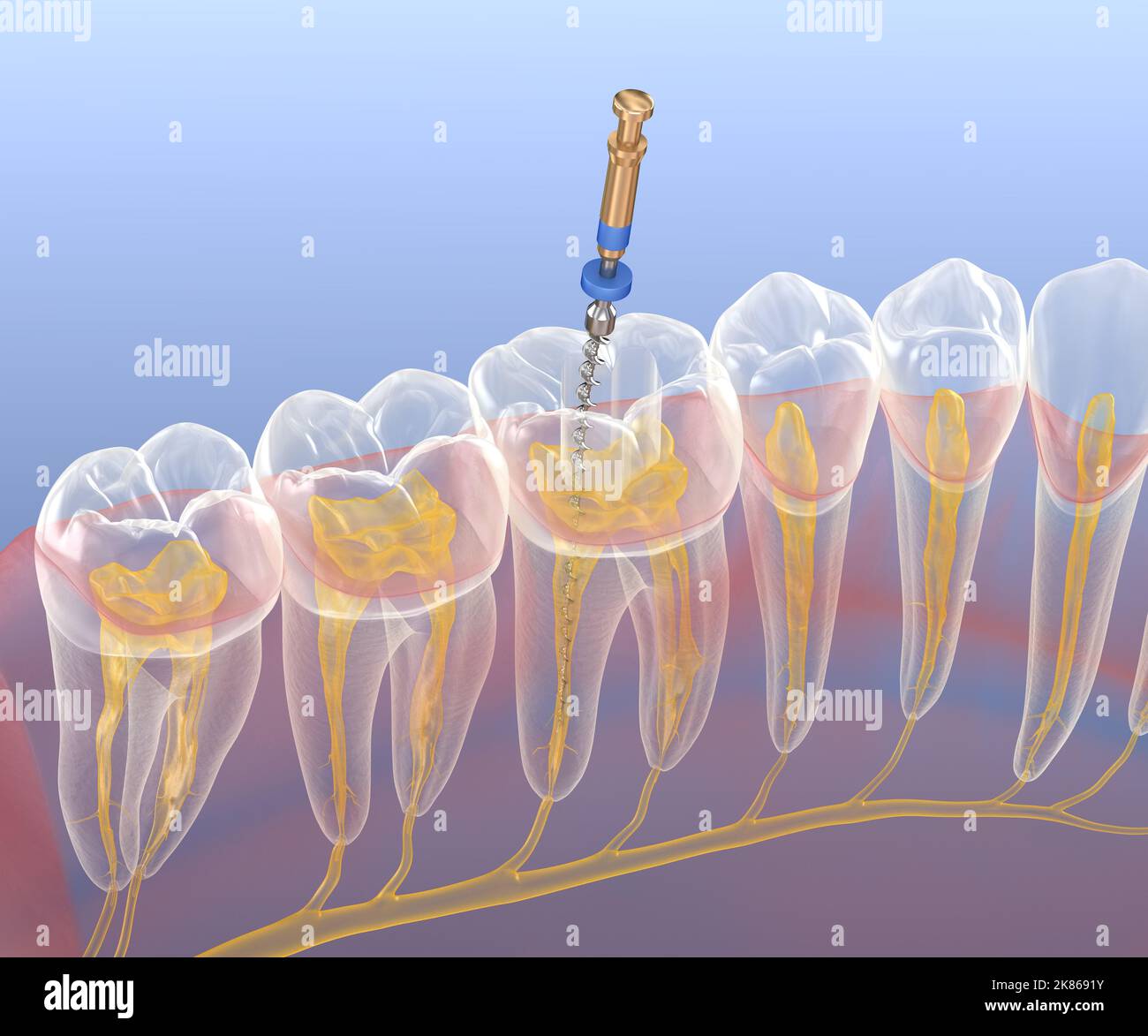 Endodontic root canal treatment process. Medically accurate tooth 3D illustration. Stock Photo