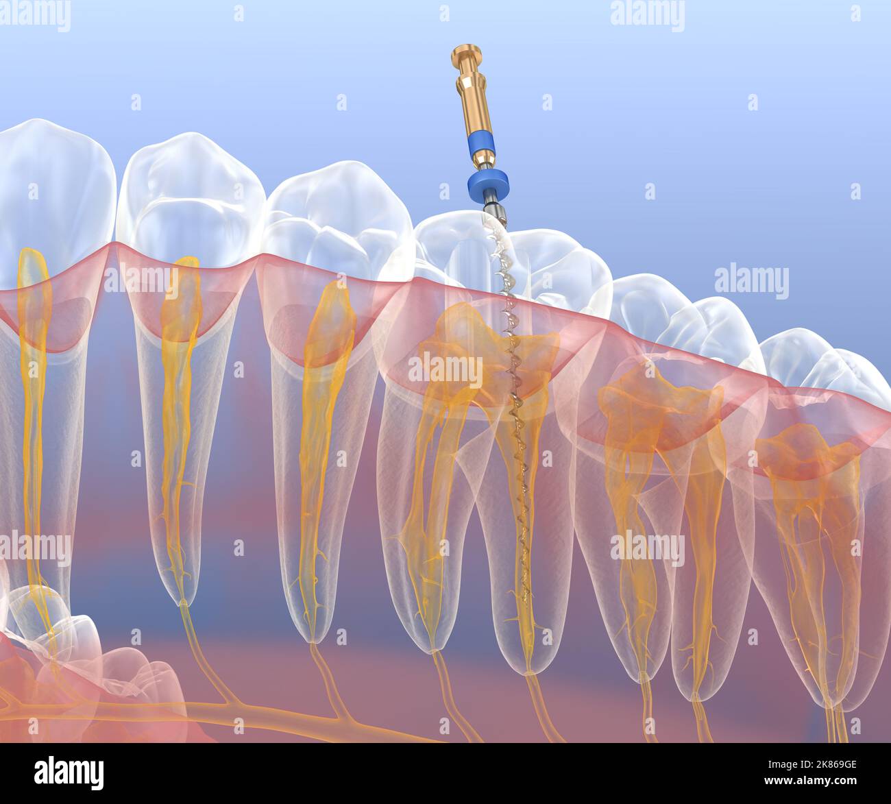 Endodontic root canal treatment process. Medically accurate tooth 3D illustration. Stock Photo