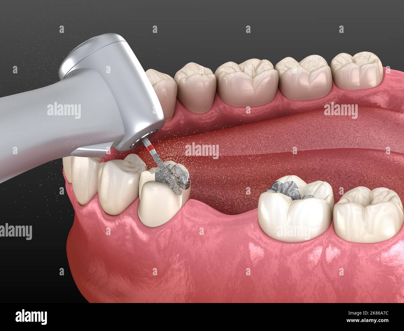 Amalgam removing and preparation for ceramic crown placement. 3D