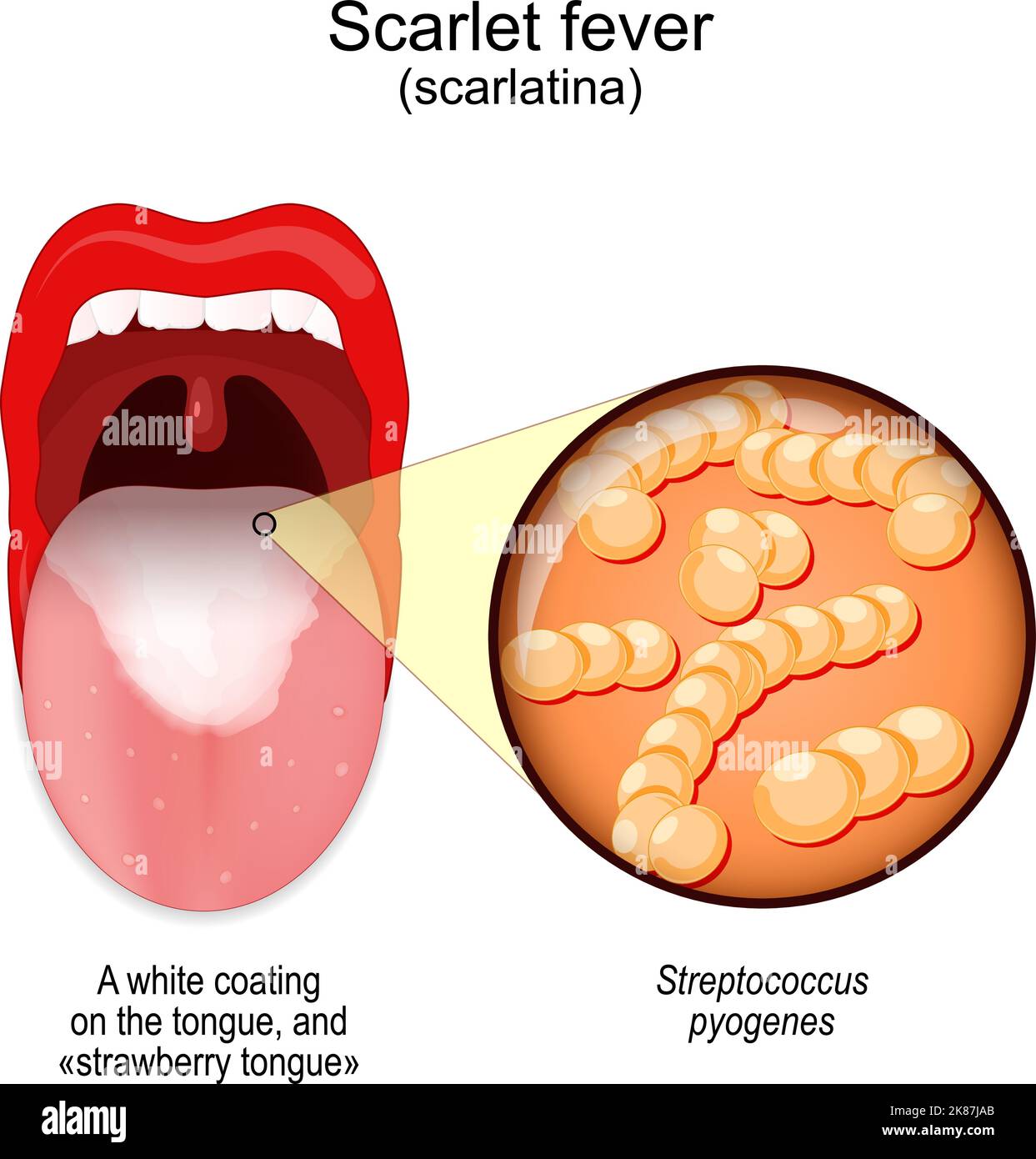 Scarlet fever. symptoms of scarlatina. Mouth with white coating on the tongue, and «strawberry tongue». Close-up of Streptococcus pyogenes. Bacteria Stock Vector