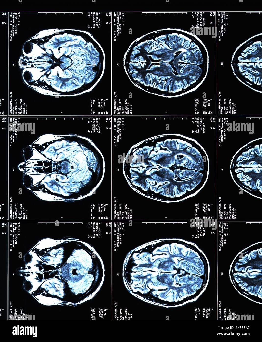 A MRI brain scans of a patient with Multiple Sclerosis Stock Photo Alamy