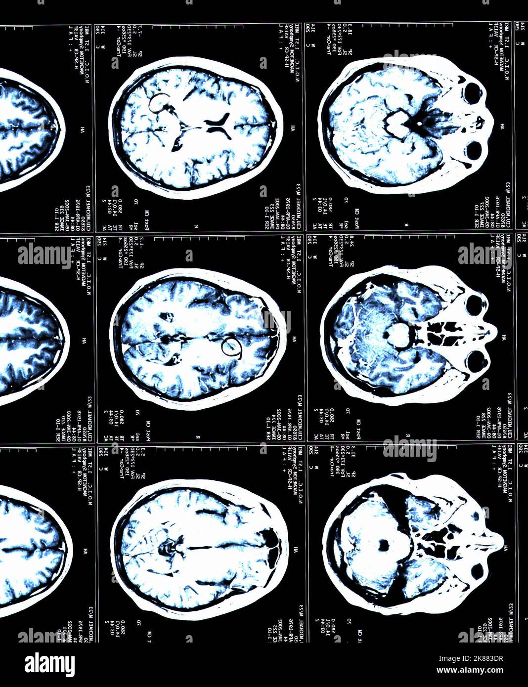 A MRI brain scans of a patient with Multiple Sclerosis Stock Photo Alamy