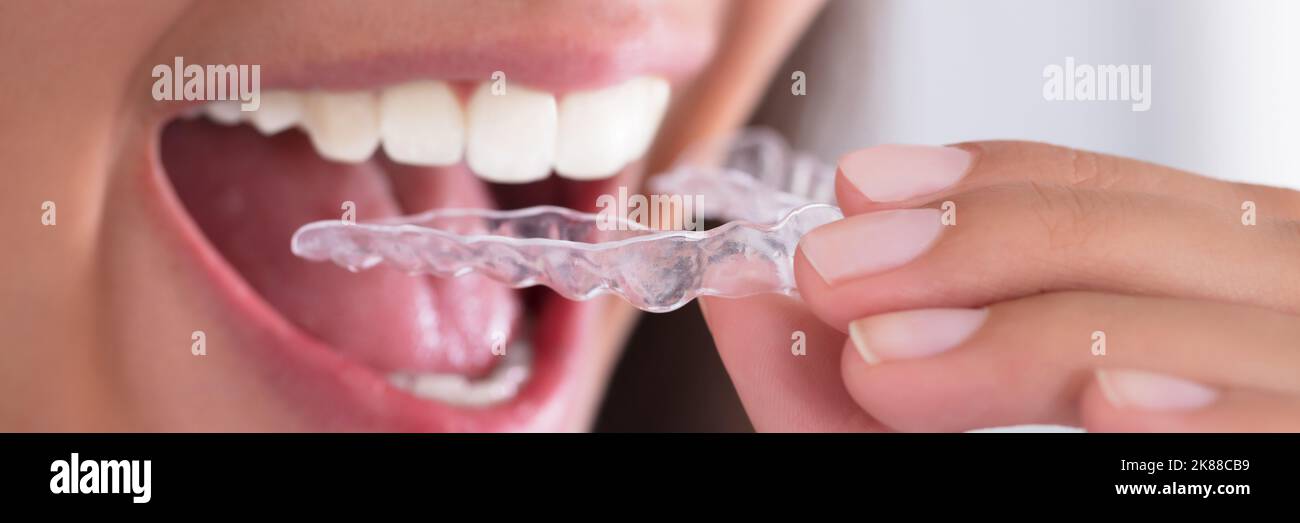 Bruxism Treatment. Invisible Orthodontic Dental Alignment Teeth Guard