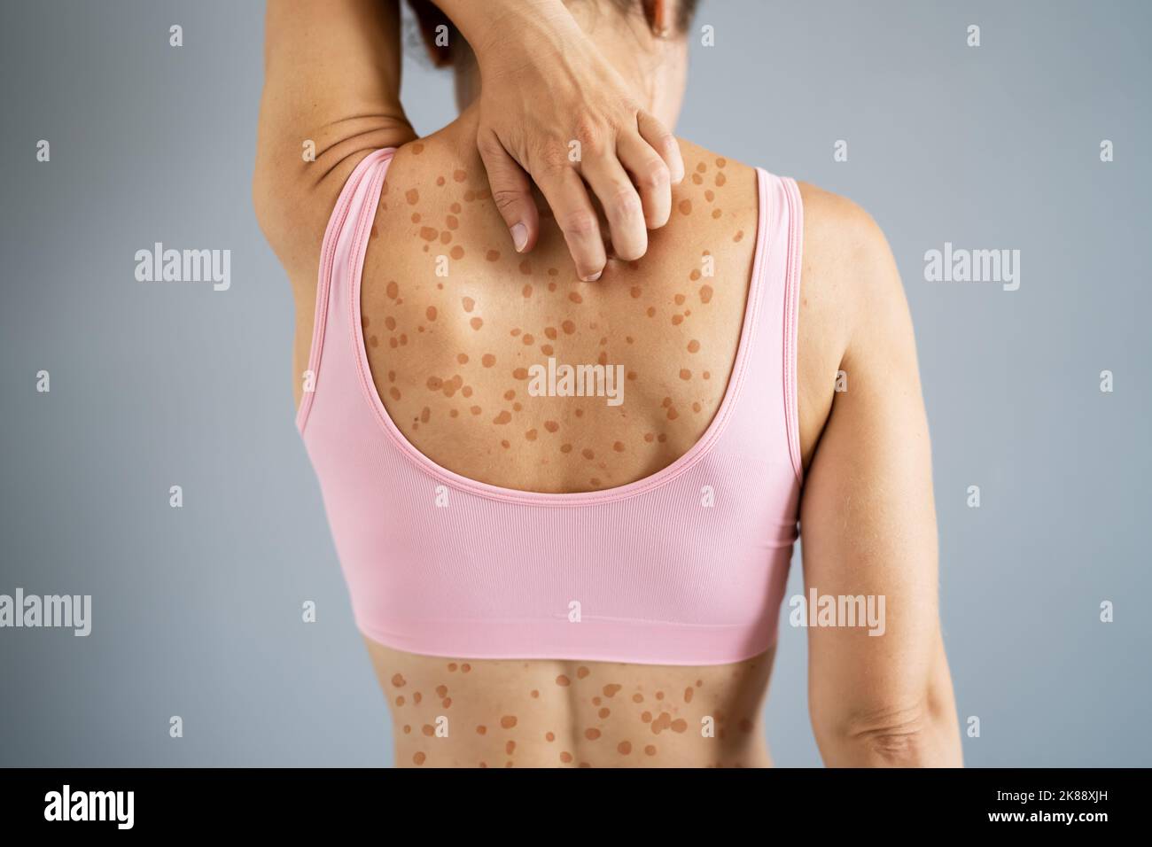 Skin Rash And Itchy Back Acne. Dry Eczema Allergy Stock Photo
