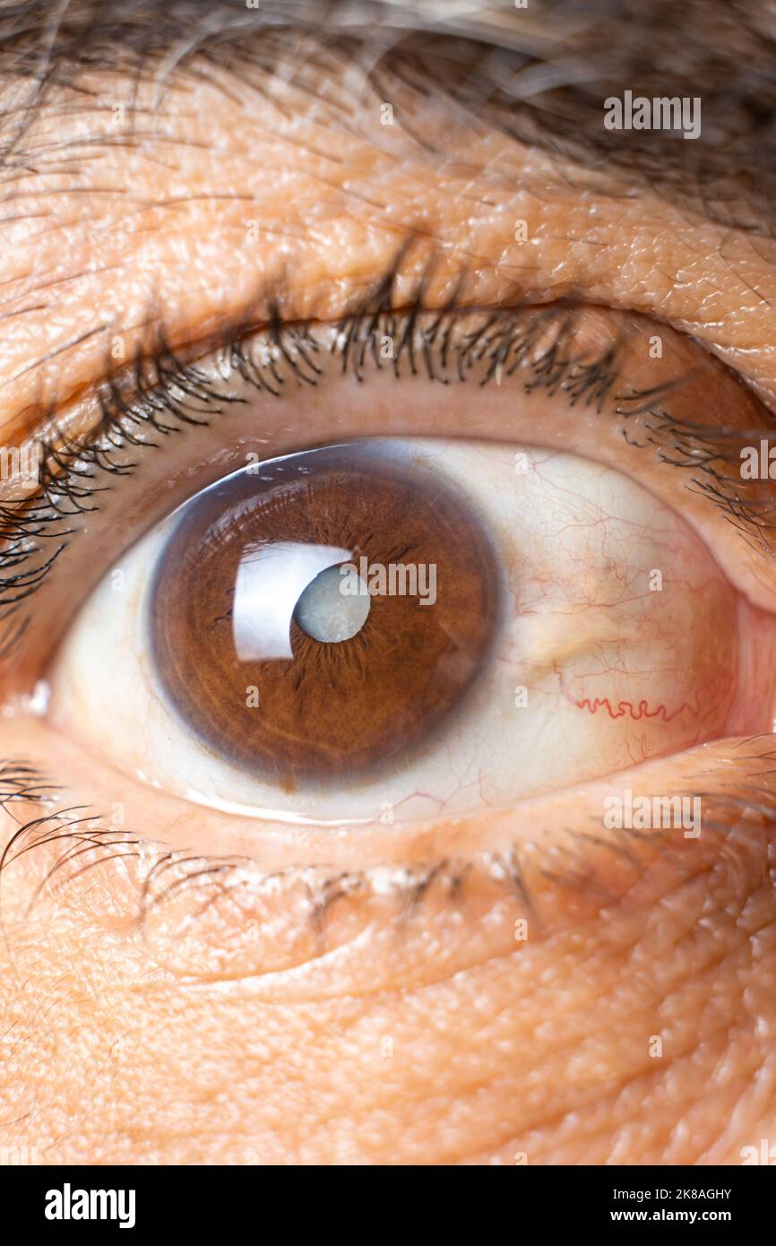Eye of an elderly man with cataracts, clouding of the lens, macro. Stock Photo