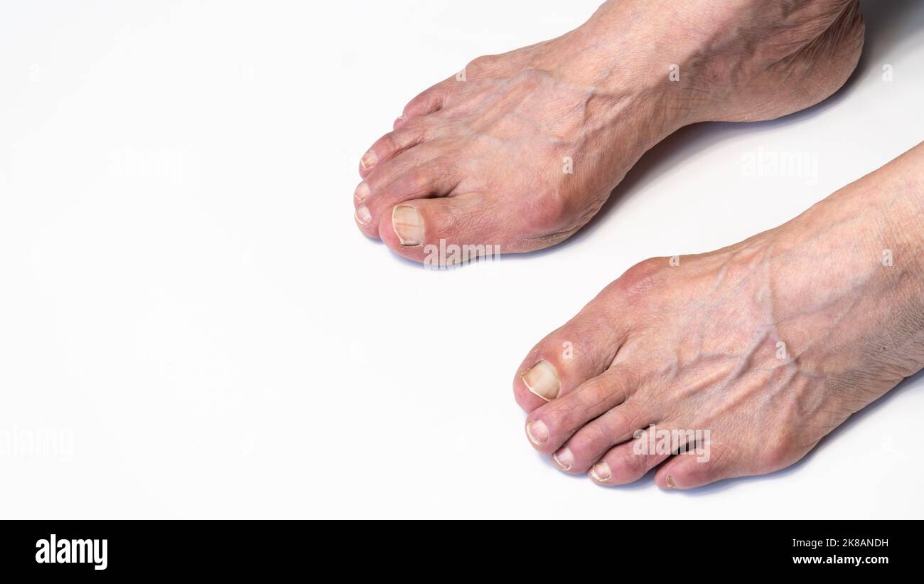 Bunion or hallux valgus on senior woman foot. Deformity of the joint ...