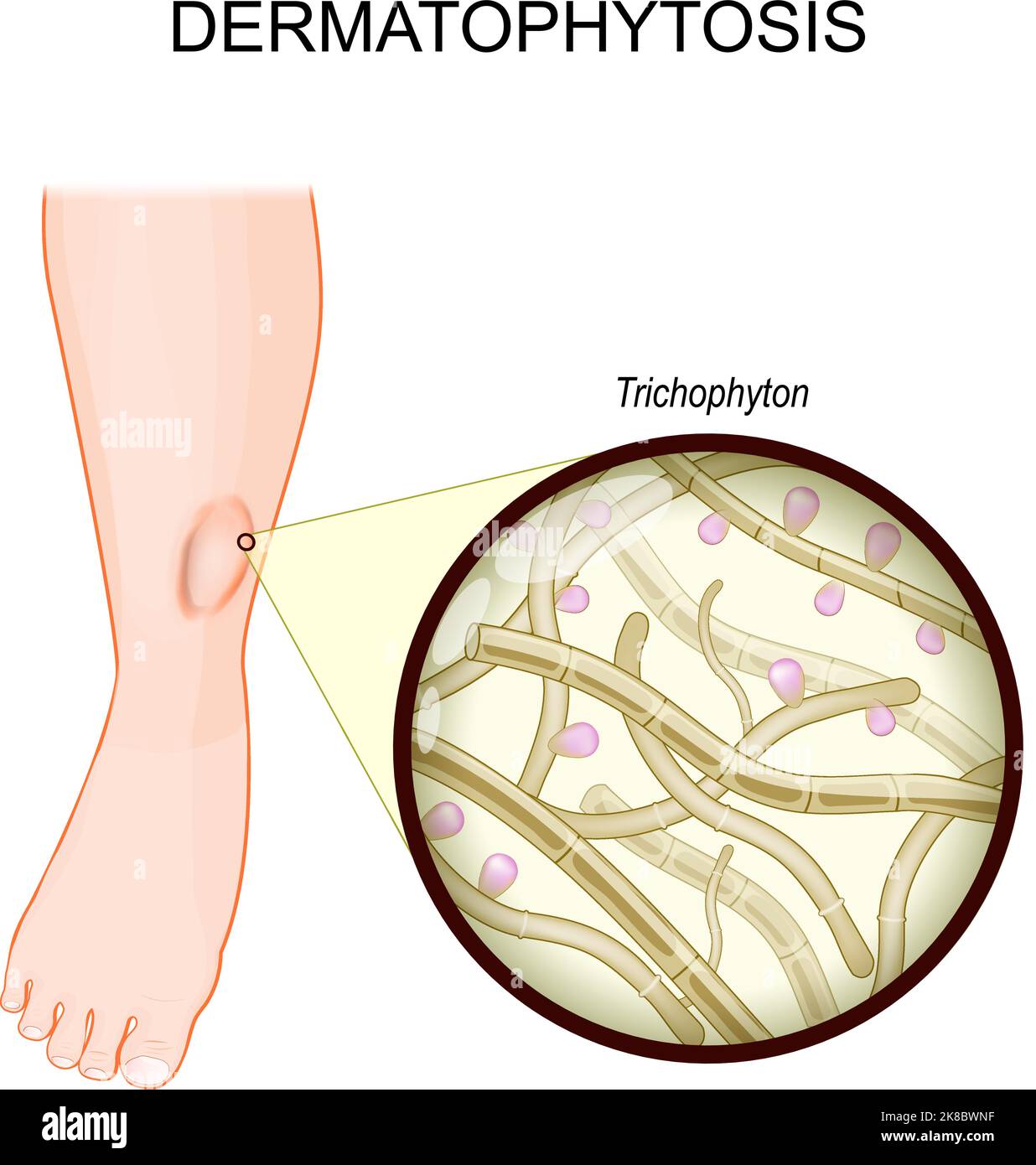 Dermatophytosis. Ringworm on a human leg. fungal infection of the skin. Close-up of a Trichophyton. fungi that caused Ringworm disease. vector Stock Vector