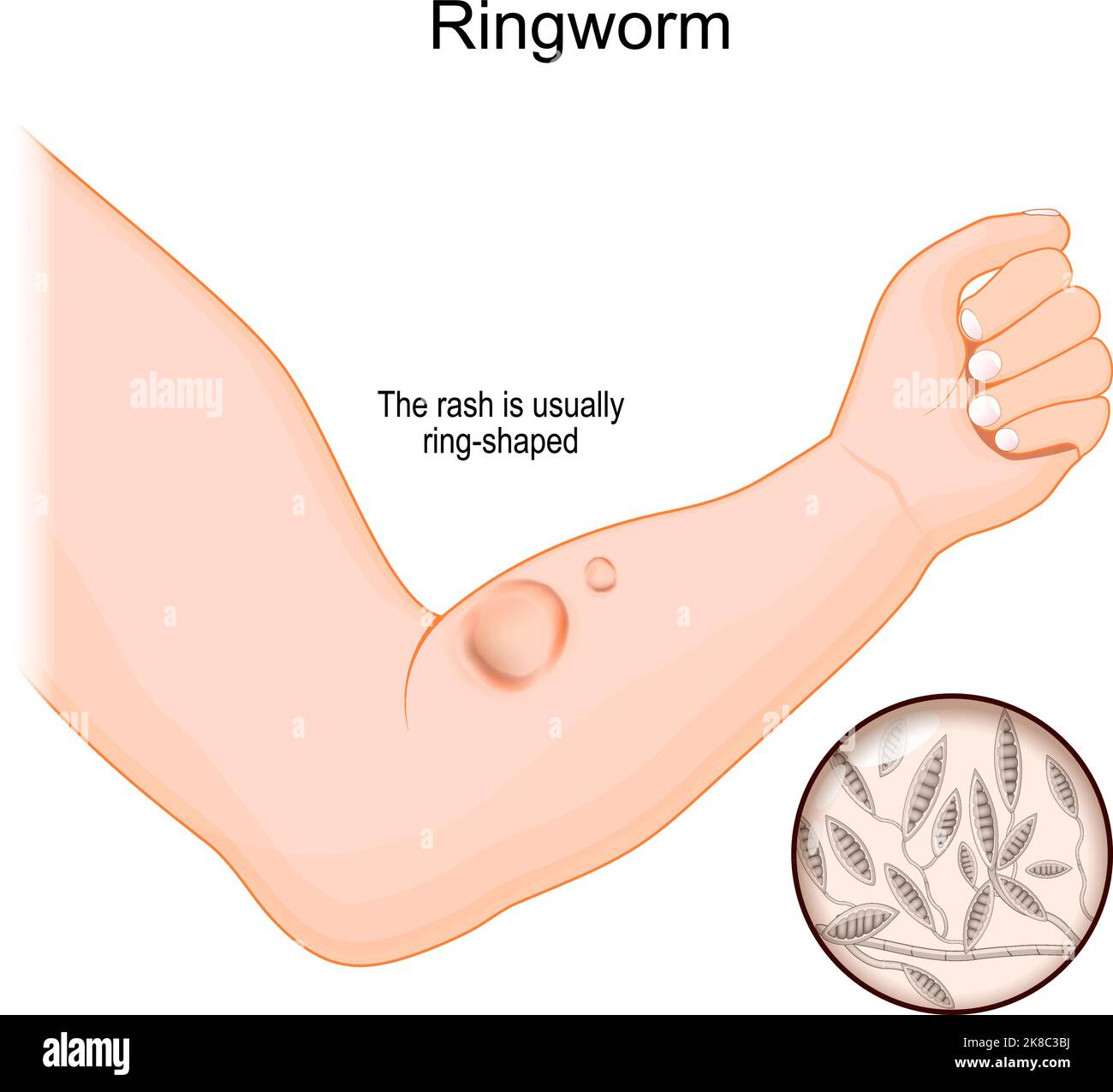 Ringworm on a human arm. fungal infection of the skin. Close-up of a fungi that caused disease. vector illustration Stock Vector